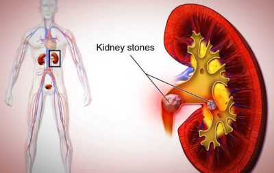 Reducing the risk of kidney stones by consuming black tea